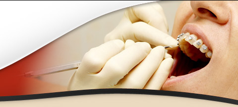 checking braces